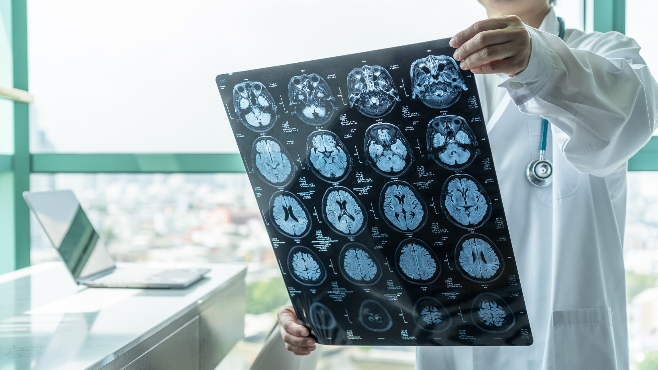 Brain disease diagnosis with medical doctor seeing Magnetic Resonance Imaging (MRI) film diagnosing elderly ageing patient neurodegenerative illness problem for neurological medical treatment for post traumatic stress disorder PTSD from car accident